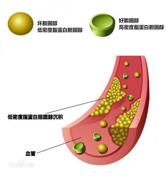 低密度脂蛋白胆固醇