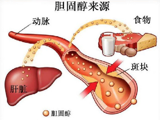 胆固醇高