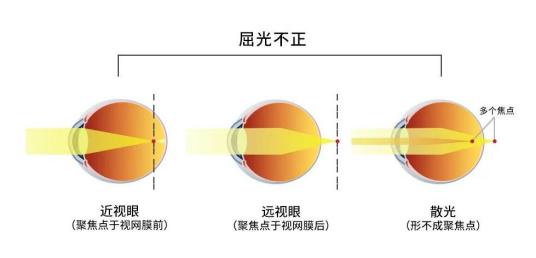 屈光不正