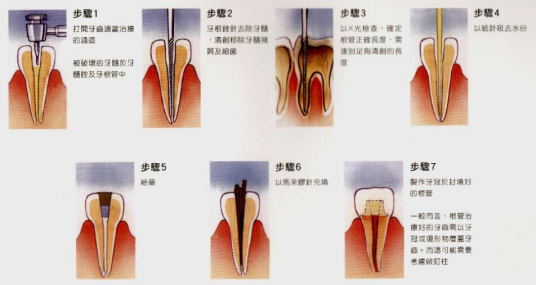 根管治疗术