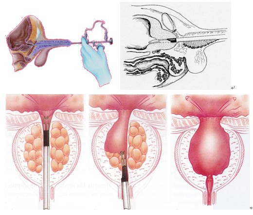 前列腺电切术