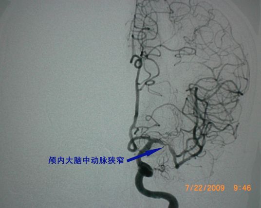 脑动脉痉挛