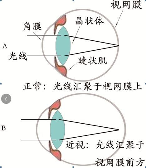 眼睛近视了两百度左右,如何才能恢复视力啊