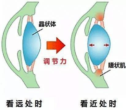 眼睛近视了两百度左右,如何才能恢复视力啊