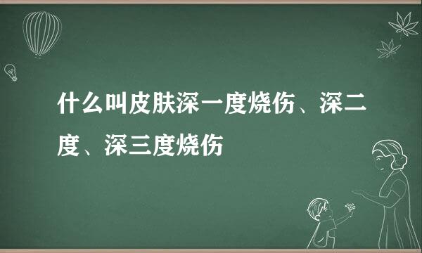 什么叫皮肤深一度烧伤、深二度、深三度烧伤