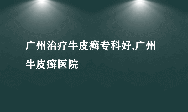 广州治疗牛皮癣专科好,广州牛皮癣医院