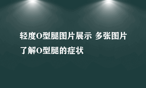 轻度O型腿图片展示 多张图片了解O型腿的症状