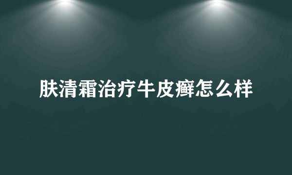 肤清霜治疗牛皮癣怎么样