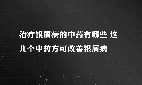 治疗银屑病的中药有哪些 这几个中药方可改善银屑病