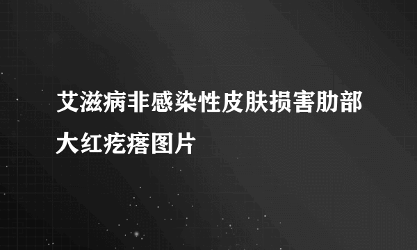 艾滋病非感染性皮肤损害肋部大红疙瘩图片