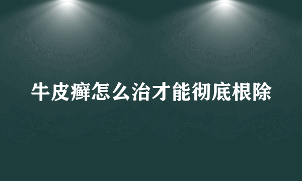 牛皮癣怎么治才能彻底根除